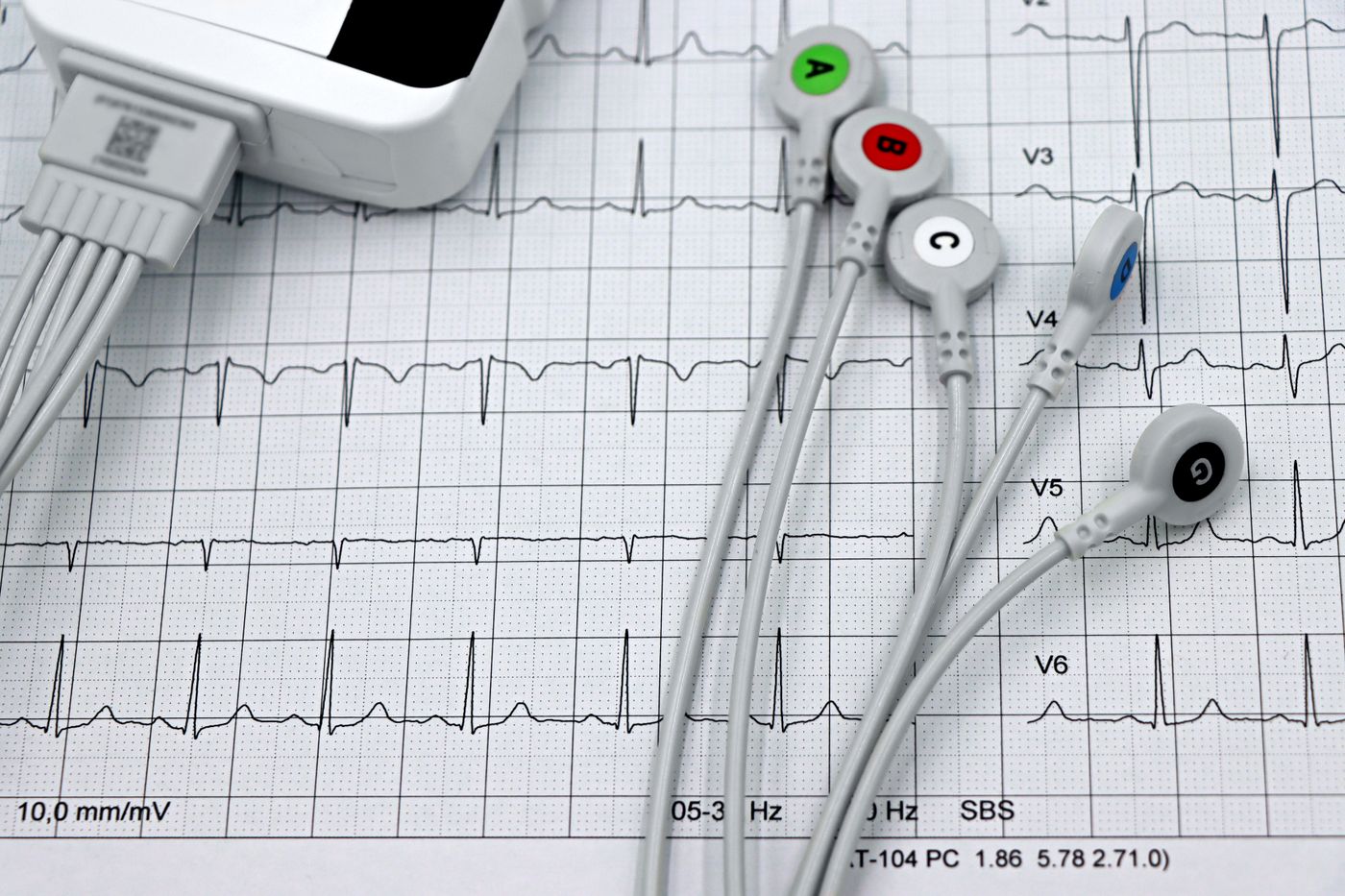 Cardiac monitor for home heart monitoring